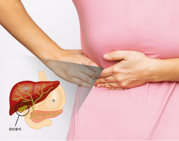 담낭 용종 제거수술과 담석 증상 치료 소화기 건강 관리