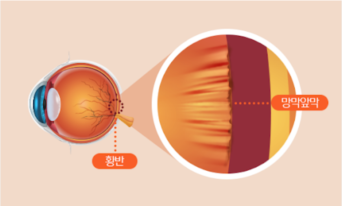망막전막으로 시야가 흐릿하고 물결치듯 왜곡되어 보이는 모습을 표현한 이미지